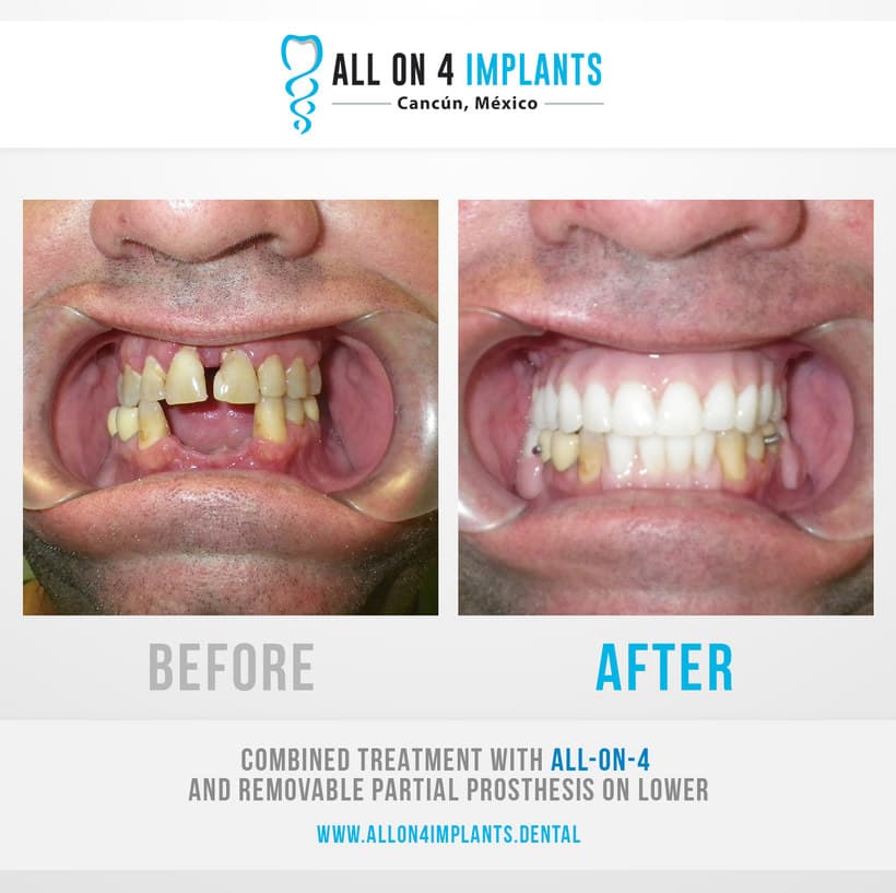 All on 4 implants Mexico
