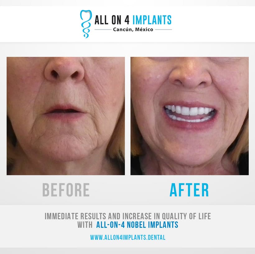 All on 4 implants Mexico
