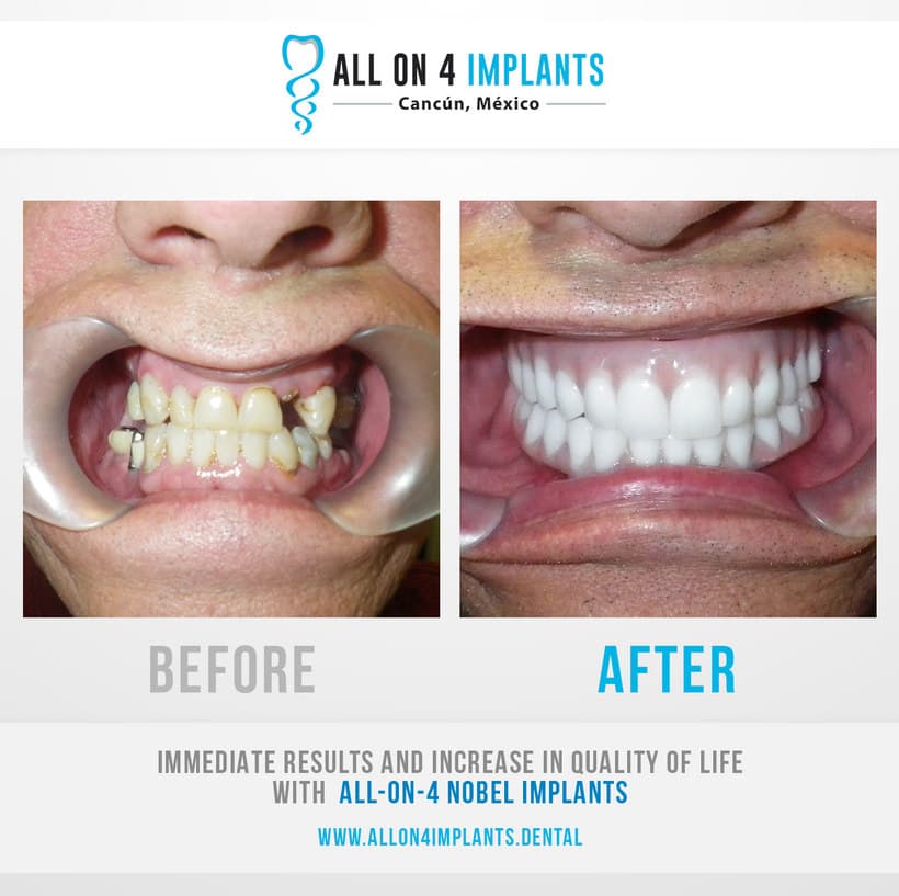 All on 4 implants Mexico